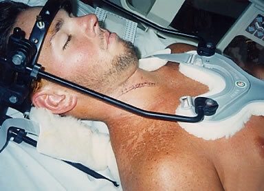 Casey Kammel at 22, in the steel halo brace during recovery in 1994